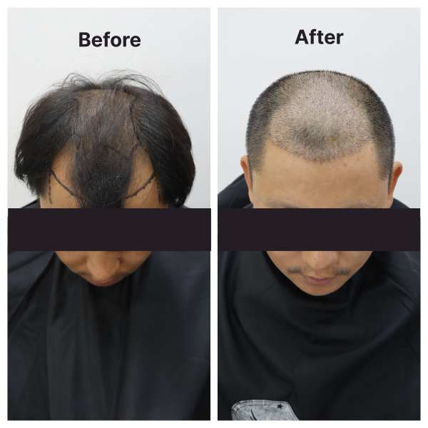 Hair Transplant result KOQ10